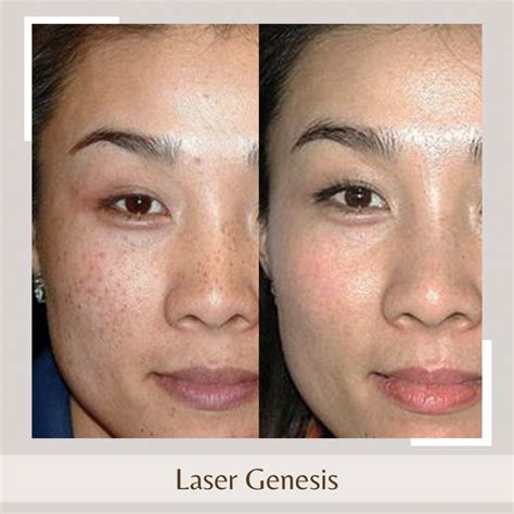 laser genesis glenelg|Booking Online .